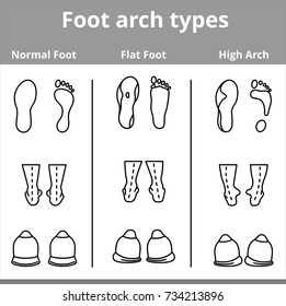 Foot arch types vector infographics. Set of flat foot, high arch