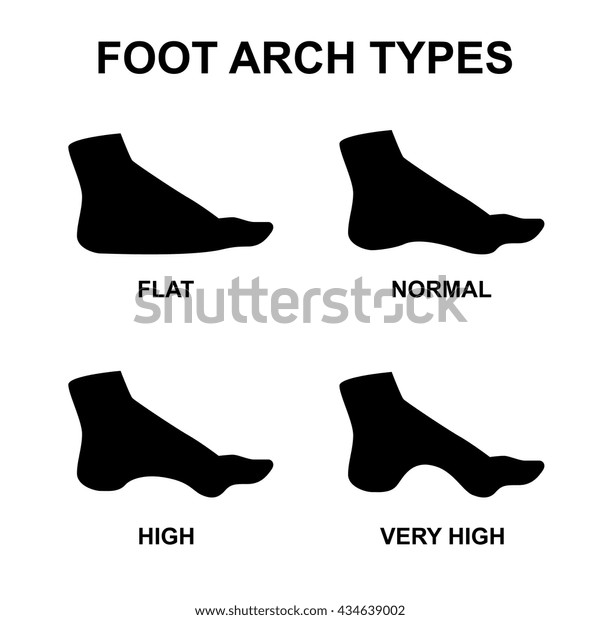 Foot Arch Types Vector Infographics Set: เวกเตอร์สต็อก (ปลอดค่า ...