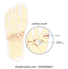 Foot bone painful displaced and Chopart's five trauma athletes heel density scan toes