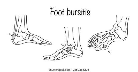Bursite do pé. Uma doença inflamatória que afeta as membranas mucosas localizadas perto das articulações do pé. Ilustrações desenhadas à mão de diferentes manifestações de joanetes. Vetor médico.