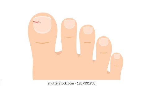 Foot cartoon vector. toe vector. wallpaper. free space for text. copy space. Tear nails.