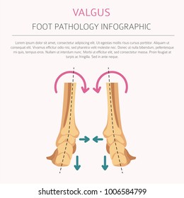 Foot deformation as medical desease infographic. Valgus and varus defect. Vector illustration