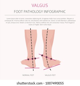 Foot deformation as medical desease infographic. Valgus and varus defect. Vector illustration