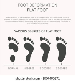 Foot deformation as medical desease infographic. Causes of Flat foot. Vector illustration
