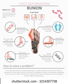 Foot deformation as medical desease infographic. Causes of bunion. Vector illustration