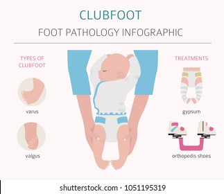 Clubfoot High Res Stock Images Shutterstock