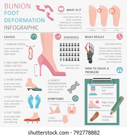Foot deformation as medical desease infographic. Causes of bunion. Vector illustration