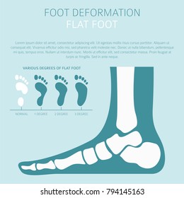 Foot deformation as medical desease infographic. Causes of Flat foot. Vector illustration