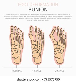 Foot deformation as medical desease infographic. Causes of bunion. Vector illustration