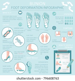 Foot deformation as medical desease infographic. Causes of bunion. Vector illustration