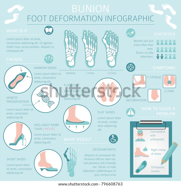 Foot Deformation Medical Desease Infographic Causes Stock Vector ...