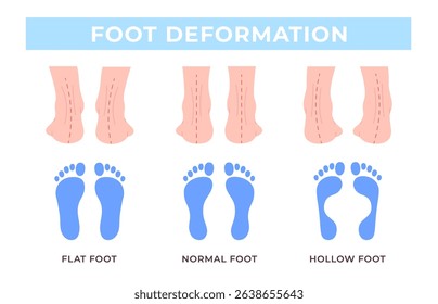 Foot deformation medical poster. Feet curvature types, normal, flat and hollow legs. Orthopedic disease info banner, human body anatomy, racy vector template