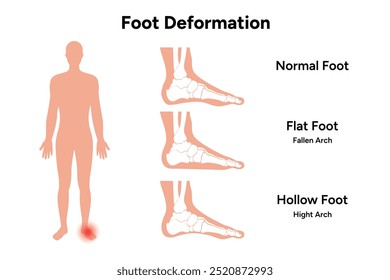 Foot deformation. Normal foot, flat and hollow foot. Fallen arch and hight arch.  Orthopedist diagram infographic