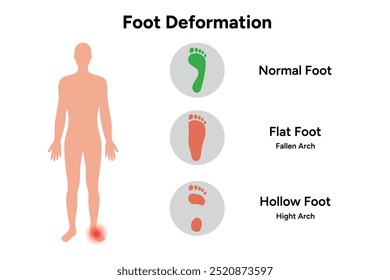 Foot deformation. Normal foot, flat and hollow foot. Fallen arch, hight arch.  Orthopedist diagram infographic