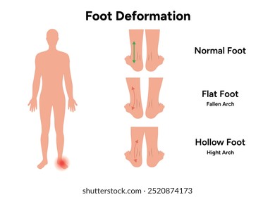 Foot deformation. Normal foot, flat and hollow foot. Hight arch and fallen arch.  Orthopedist diagram infographic