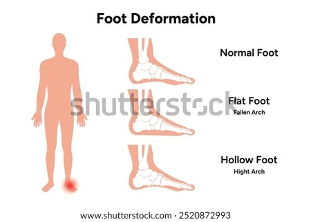 Foot deformation. Normal foot, flat and hollow foot. Fallen arch and hight arch.  Orthopedist diagram infographic