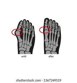 Foot deformation. Simple vector illustration.