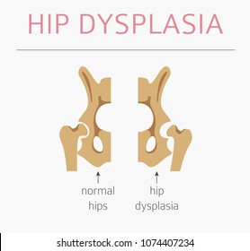 Foot Deformation Types,  Medical Desease Infographic. Hip Dysplasia In Children. Vector Illustration