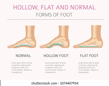 Foot deformation types,  medical desease infographic. Hollow, flat and normal foot. Vector illustration