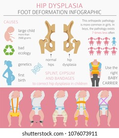 Foot Deformation Types,  Medical Desease Infographic. Hip Dysplasia In Children. Vector Illustration