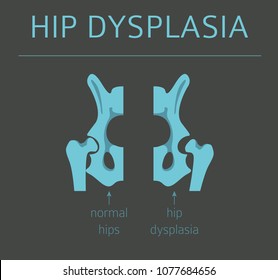 Foot Deformation Types,  Medical Desease Infographic. Hip Dysplasia In Children. Vector Illustration