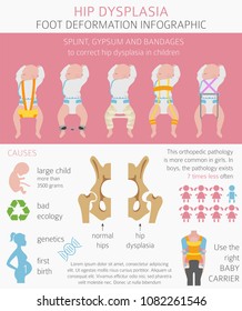 Foot deformation types,  medical desease infographic. Hip dysplasia in children. Vector illustration