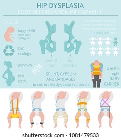 Foot Deformation Types,  Medical Disease Infographic. Hip Dysplasia In Children. Vector Illustration