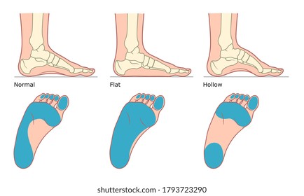 Foot deformation types medical infographic. Vector illustration. 