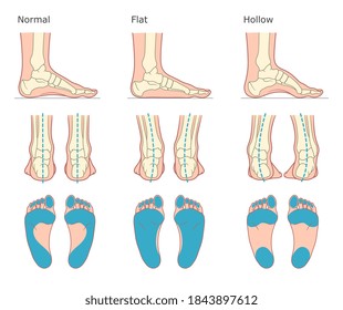 Foot Deformation Types Medical Infographic. Vector Illustration.