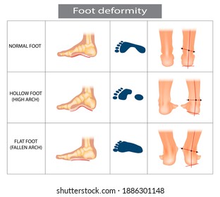 Foot deformation. Types pathologies of foot. Hollow, flat and normal foot. Medical infographic.