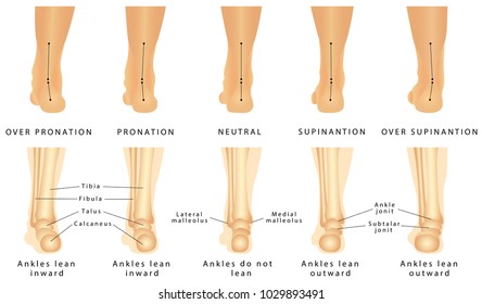 Foot Deformation - Valgus And Varus Defect. Normal Human Foot And The Foot With Pronation Or Flatfoot, With Hindfoot Deformity.

