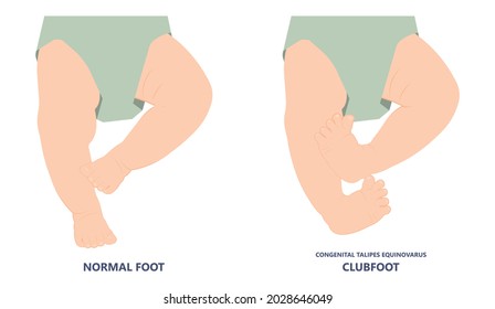 Foot Deformities Infant Turned Inward Upward Birth Baby Tendon Leg Muscle Bone Twist Feet Child Limb Spina Bifida Varus Valgus Talus Ankle Gene Heel Cavus Equinus Tibial Bow Cleft Lip Test Toe Drop