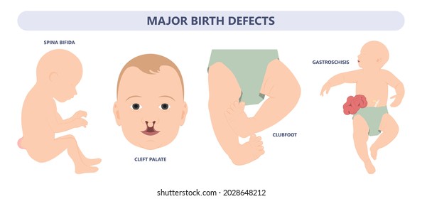 foot deformities infant turned inward upward birth baby tendon leg muscle bone twist feet child limb spina bifida varus valgus talus ankle gene heel Cavus Equinus tibial bow Cleft Lip test toe drop