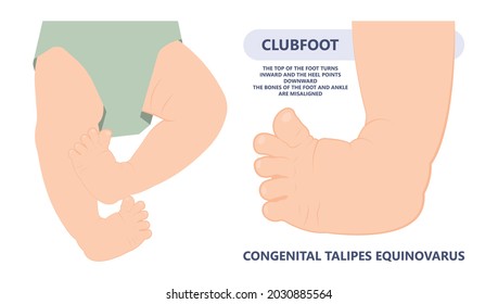 Foot Deformities Infant Turned Inward Upward Birth Baby Tendon Leg Muscle Bone Twist Feet Child Limb Spina Bifida Varus Valgus Talus Ankle Gene Heel Cavus Equinus Tibial Bow Cleft Lip Test Toe Drop