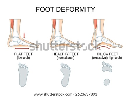 Foot deformity. Healthy feet with normal arch and footprint. Flat feet with low arch, entire sole to touch the ground. Excessively high arch. Vector illustration. Medical poster. Schematic diagram