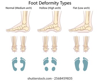 foot deformity types, normal arch, hollow high arch, and flat low arch, anatomical and footprint views diagram hand drawn schematic vector illustration. Medical science educational illustration