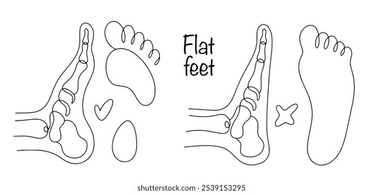 A foot deformity in which the longitudinal arch becomes flattened. A simple illustration of a healthy leg and a leg with flat feet. Medical vector on white background.