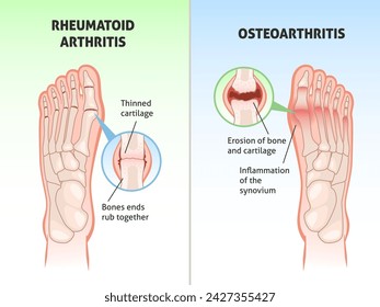 Foot disease poster. Medical orthopedic scheme, foot bones defects, joint with rheumatoid arthritis and osteoarthritis diagnosis, educational scheme, medic poster, tidy vector concept