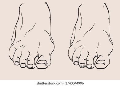 foot drawn with podiatry problems. Fingers and nails to be restored for the podiatrist