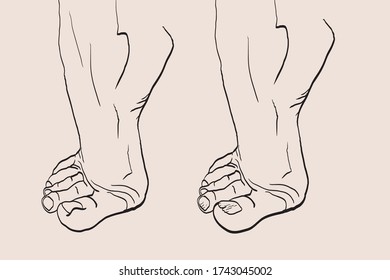 foot drawn with podiatry problems. Fingers and nails to be restored for the podiatrist