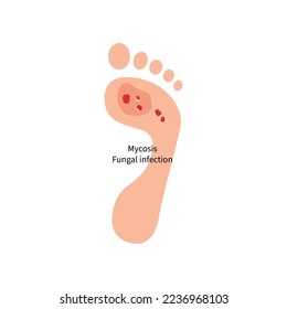 Foot with fungal skin disease. Podology, podologist illustration, infectious disease of feet