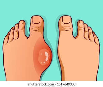 Foot with gout, before-after.  Hallux valgus. Vector illustration