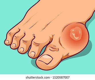  Foot with gout, before-after.  Hallux valgus. Vector illustration