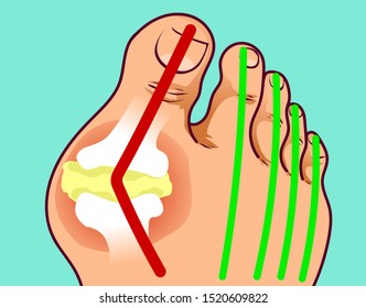 Foot with gout, before-after. Hallux valgus. Vector illustration