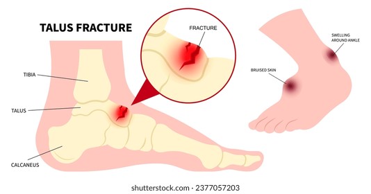 La anatomía de la fractura de hueso de pie que causa por lesión en caída con síntoma de dolor en