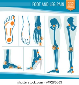 Foot And Leg Pain. Arthritis And Rheumatism Orthopedic Medical Vector Diagram. Illustration Of Rheumatism Leg Joint