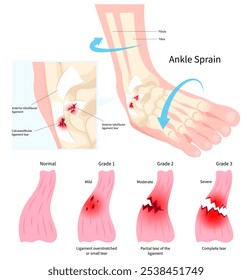 Classificação da ruptura e lesão dos ligamentos do tornozelo que causa dor no pé