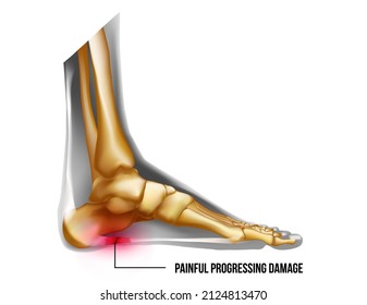 Foot pain, plantar fasciitis inflammation and ruptures strain realistic anatomy illustration