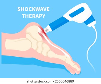 Foot pain treatment by Shockwave therapy to treat muscle repetitive strain tear or overuse injury with Golfer’s elbow syndrome and Morton’s neuroma disease in medical