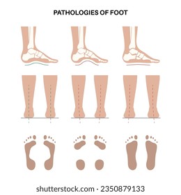 Foot pathologies anatomical poster. Flat, normal and hollow feet conditions. Abnormal feet arch, supination and overpronation. Ankle pathology diagnostic in podiatry clinic medical vector illustration